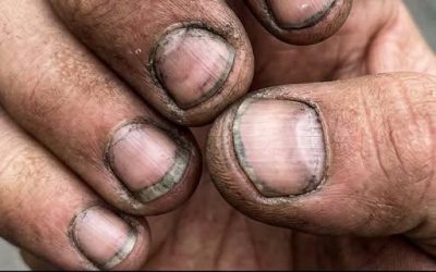 ¿Cómo se llama a una persona que tiene las uñas así?