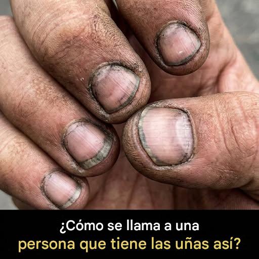 ¿Cómo se llama a una persona que tiene las uñas así?
