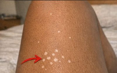 ¿Por qué aparecen manchas blancas en la piel?