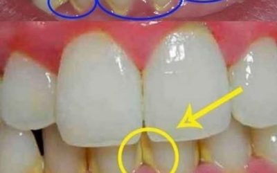 Elimina la placa en 5 minutos de forma natural, sin ir al dentista