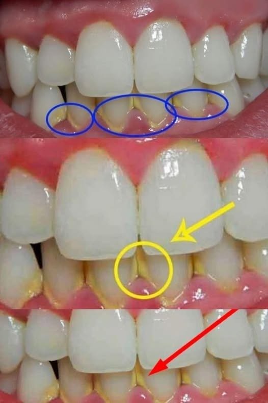 Elimina la placa en 5 minutos de forma natural, sin ir al dentista