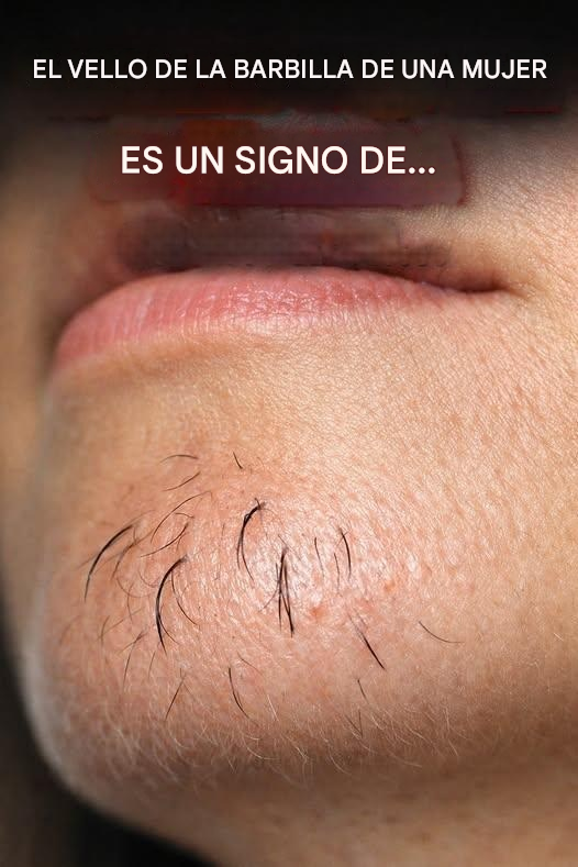 El vello en la barbilla de una mujer es un signo de… Ver más