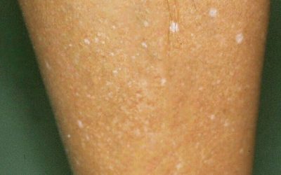 ¿Qué hay detrás de las manchas blancas en la piel? Estas son las posibles causas.