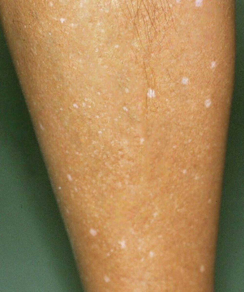 ¿Qué hay detrás de las manchas blancas en la piel? Estas son las posibles causas.